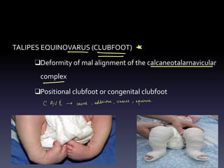 TALIPES EQUINOVARUS (CLUBFOOT)
❑Deformity of mal alignment of the calcaneotalarnavicular
complex
❑Positional clubfoot or congenital clubfoot
Al
-
-
- -
-
CAVE + cavus ,
adductus ,
varus ,
equinus
.
 