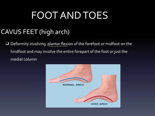 FOOT ANDTOES
CAVUS FEET (high arch)
❑ Deformity involving plantar flexion of the forefoot or midfoot on the
hindfoot and may involve the entire forepart of the foot or just the
medial column
- -
 