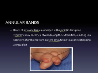 ANNULAR BANDS
– Bands of amniotic tissue associated with amniotic disruption
syndrome may become entwined along the extremities, resulting in a
spectrum of problems from in utero amputation to a constriction ring
along a digit
-
-
-
- -
 