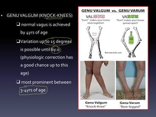 • GENUVALGUM (KNOCK-KNEES)
❑ normal vagus is achieved
by 4yrs of age
❑Variation up to 15 degrees
is possible until 6y.o
(physiologic correction has
a good chance up to this
age)
❑ most prominent between
3-4yrs of age
-
-
O
O
E
 