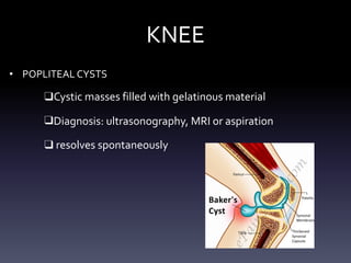 KNEE
• POPLITEAL CYSTS
❑Cystic masses filled with gelatinous material
❑Diagnosis: ultrasonography, MRI or aspiration
❑ resolves spontaneously
 