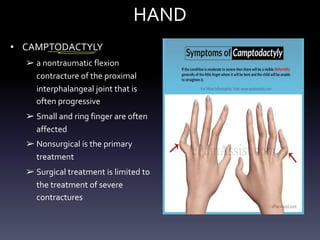 HAND
• CAMPTODACTYLY
➢ a nontraumatic flexion
contracture of the proximal
interphalangeal joint that is
often progressive
➢ Small and ring finger are often
affected
➢ Nonsurgical is the primary
treatment
➢ Surgical treatment is limited to
the treatment of severe
contractures
- -
- -
 