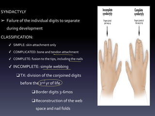 SYNDACTYLY
➢ Failure of the individual digits to separate
during development
CLASSIFICATION:
✓ SIMPLE: skin attachment only
✓ COMPLICATED: bone and tendon attachment
✓ COMPLETE: fusion to the tips, including the nails
✓ INCOMPLETE: simple webbing
❑TX: division of the conjoined digits
before the 2nd yr of life
❑Border digits 3-6mos
❑Reconstruction of the web
space and nail folds
- -
- -
-
-
 