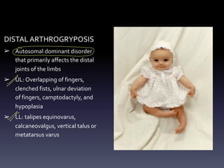 DISTAL ARTHROGRYPOSIS
➢ Autosomal dominant disorder
that primarily affects the distal
joints of the limbs
➢ UL: Overlapping of fingers,
clenched fists, ulnar deviation
of fingers, camptodactyly, and
hypoplasia
➢ LL: talipes equinovarus,
calcaneovalgus, vertical talus or
metatarsus varus
-
X
I
 