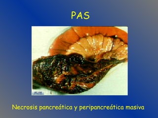 PAS Necrosis pancreática y peripancreática masiva 