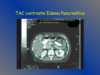 TAC contraste Edema Pancreático 