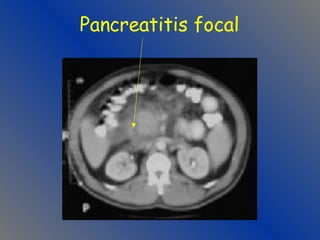 Pancreatitis focal 