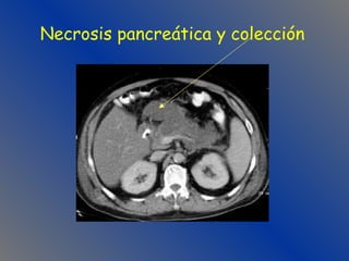 Necrosis pancreática y colección 