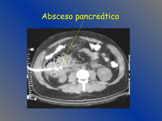 Absceso pancreático 