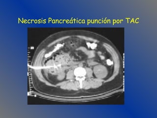 Necrosis Pancreática punción por TAC 