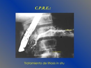 C.P.R.E.: C.Pancr.princ. Lito en col?doco Tratamiento de litiasis in situ  