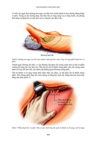 NGOẠI KHOA LÂM SÀNG-2007


Có thể vào ngực theo đường mở ngực sau bên tiêu chuẩn (hình 6) hay đường thẳng đứng
ở nách. Trong cả hai trường hợp, nên bảo tồn cơ lưng rộng và cơ răng trước, dự phòng
khả năng sử dụng hai cơ này làm vạt cơ chuyển vào lấp ổ cặn.




Hình 6- Đường mở ngực sau bên tiêu chuẩn ở khoang liên sườn 5 hay 6 trong phẫu thuật bóc vỏ
phổi
Thành ngực thường rất chắc, vì vậy thường cần phải cắt xương sườn mới có thể có phẫu
trường đủ rộng cho các thao tác. Nếu dự trù cắt lá thành màng phổi, nên cắt xương sườn
dưới cốt mạc để làm mốc xác định mặt phẳng ngoài khoang màng phổi.
Nếu lá thành và lá tạng màng phổi dính chặt vào nhau, có thể phải cắt lá thành màng
phổi. Nếu chúng dính lỏng lẽo, tách chúng ra bằng bóc tách sắc (dùng dao hay kéo) hay
bằng dao điện (hình 7).




Hình 7-Phẫu thuật bóc vỏ phổi. Nếu có dây dính lỏng lẽo giữa lá thành và lá tạng, tách lá tạng


                                             484
 