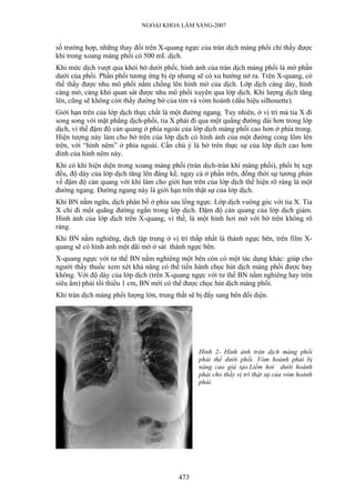 NGOẠI KHOA LÂM SÀNG-2007


số trường hợp, những thay đổi trên X-quang ngực của tràn dịch màng phổi chỉ thấy được
khi trong xoang màng phổi có 500 mL dịch.
Khi mức dịch vượt qua khỏi bờ dưới phổi, hình ảnh của tràn dịch màng phổi là mờ phần
dưới của phổi. Phần phổi tương ứng bị ép nhưng sẽ có xu hướng nở ra. Trên X-quang, có
thể thấy được nhu mô phổi nằm chồng lên hình mờ của dịch. Lớp dịch càng dày, hình
càng mờ, càng khó quan sát được nhu mô phổi xuyên qua lớp dịch. Khi lượng dịch tăng
lên, cũng sẽ không còn thấy đường bờ của tim và vòm hoành (dấu hiệu silhouette).
Giới hạn trên của lớp dịch thực chất là một đường ngang. Tuy nhiên, ở vị trí mà tia X đi
song song với mặt phẳng dịch-phổi, tia X phải đi qua một quãng đường dài hơn trong lớp
dịch, vì thế đậm độ cản quang ở phía ngoài của lớp dịch màng phổi cao hơn ở phía trong.
Hiện tượng này làm cho bờ trên của lớp dịch có hình ảnh của một đường cong lõm lên
trên, với “hình nêm” ở phía ngoài. Cần chú ý là bờ trên thực sự của lớp dịch cao hơn
đỉnh của hình nêm này.
Khi có khí hiện diện trong xoang màng phổi (tràn dịch-tràn khí màng phổi), phổi bị xẹp
đều, độ dày của lớp dịch tăng lên đáng kể, ngay cả ở phần trên, đồng thời sự tương phản
về đậm độ cản quang với khí làm cho giới hạn trên của lớp dịch thể hiện rõ ràng là một
đường ngang. Đường ngang này là giới hạn trên thật sự của lớp dịch.
Khi BN nằm ngữa, dịch phân bố ở phía sau lồng ngực. Lớp dịch vuông góc với tia X. Tia
X chỉ đi một quãng đường ngắn trong lớp dịch. Đậm độ cản quang của lớp dịch giảm.
Hình ảnh của lớp dịch trên X-quang, vì thế, là một hình hơi mờ với bờ trên không rõ
ràng.
Khi BN nằm nghiêng, dịch tập trung ở vị trí thấp nhất là thành ngực bên, trên film X-
quang sẽ có hình ảnh một dãi mờ ở sát thành ngực bên.
X-quang ngực với tư thế BN nằm nghiêng một bên còn có một tác dụng khác: giúp cho
người thầy thuốc xem xét khả năng có thể tiến hành chọc hút dịch màng phổi được hay
không. Với độ dày của lớp dịch (trên X-quang ngực với tư thế BN nằm nghiêng hay trên
siêu âm) phải tối thiểu 1 cm, BN mới có thể được chọc hút dịch màng phổi.
Khi tràn dịch màng phổi lượng lớn, trung thất sẽ bị đẩy sang bên đối diện.




                                                 Hình 2- Hình ảnh tràn dịch màng phổi
                                                 phải thể dưới phổi. Vòm hoành phải bị
                                                 nâng cao giả tạo.Liềm hơi dưới hoành
                                                 phải cho thấy vị trí thật sự của vòm hoành
                                                 phải.




                                          473
 