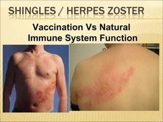 Vaccination Vs Natural
Immune System Function
 