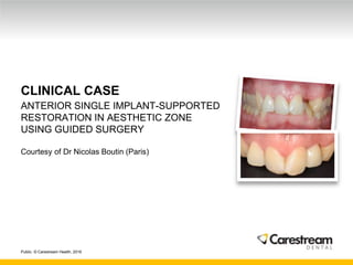 Public. © Carestream Health, 2016
CLINICAL CASE
ANTERIOR SINGLE IMPLANT-SUPPORTED
RESTORATION IN AESTHETIC ZONE
USING GUIDED SURGERY
Courtesy of Dr Nicolas Boutin (Paris)
 