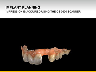 Unrestricted Internal Use. © Carestream Health, 2016
IMPLANT PLANNING
IMPRESSION IS ACQUIRED USING THE CS 3600 SCANNER
 