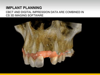 Unrestricted Internal Use. © Carestream Health, 2016
IMPLANT PLANNING
CBCT AND DIGITAL IMPRESSION DATA ARE COMBINED IN
CS 3D IMAGING SOFTWARE
 