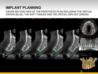 Unrestricted Internal Use. © Carestream Health, 2016
IMPLANT PLANNING
CROSS SECTION VIEW OF THE PROSTHETIC PLAN INCLUDING THE VIRTUAL
CROWN (BLUE), THE SOFT TISSUES AND THE VIRTUAL IMPLANT (GREEN)
 