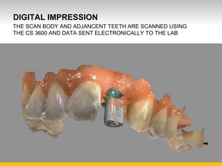Unrestricted Internal Use. © Carestream Health, 2016
DIGITAL IMPRESSION
THE SCAN BODY AND ADJANCENT TEETH ARE SCANNED USING
THE CS 3600 AND DATA SENT ELECTRONICALLY TO THE LAB
 