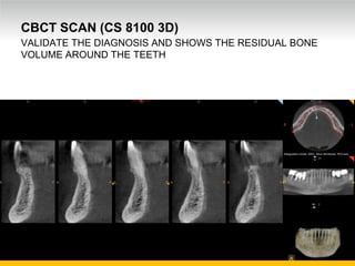 Unrestricted Internal Use. © Carestream Health, 2016
CBCT SCAN (CS 8100 3D)
VALIDATE THE DIAGNOSIS AND SHOWS THE RESIDUAL BONE
VOLUME AROUND THE TEETH
 