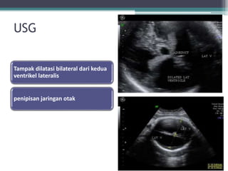 USG
Tampak dilatasi bilateral dari kedua
ventrikel lateralis
penipisan jaringan otak
 