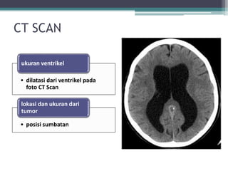 CT SCAN
• dilatasi dari ventrikel pada
foto CT Scan
ukuran ventrikel
• posisi sumbatan
lokasi dan ukuran dari
tumor
 