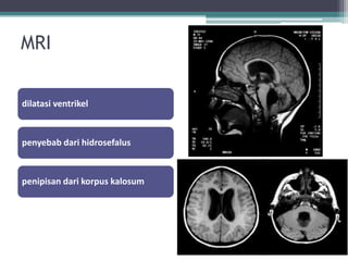 MRI
dilatasi ventrikel
penyebab dari hidrosefalus
penipisan dari korpus kalosum
 