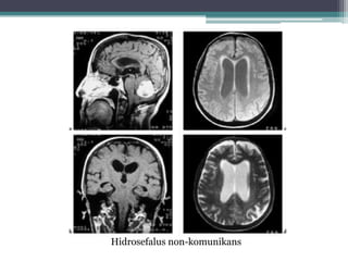 Hidrosefalus non-komunikans
 