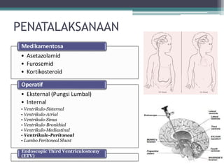 PENATALAKSANAAN
• Asetazolamid
• Furosemid
• Kortikosteroid
Medikamentosa
• Eksternal (Pungsi Lumbal)
• Internal
• Ventrikulo-Sisternal
• Ventrikulo-Atrial
• Ventrikulo-Sinus
• Ventrikulo-Bronkhial
• Ventrikulo-Mediastinal
• Ventrikulo-Peritoneal
• Lumbo Peritoneal Shunt
Operatif
Endoscopic Third Ventriculostomy
(ETV)
 