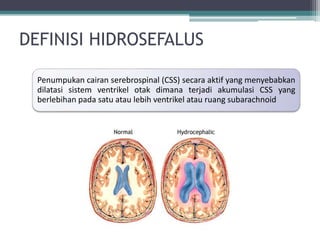 DEFINISI HIDROSEFALUS
Penumpukan cairan serebrospinal (CSS) secara aktif yang menyebabkan
dilatasi sistem ventrikel otak dimana terjadi akumulasi CSS yang
berlebihan pada satu atau lebih ventrikel atau ruang subarachnoid
 