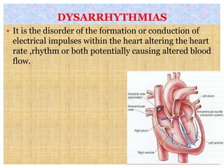DYSARRHYTHMIAS
 It is the disorder of the formation or conduction of
electrical impulses within the heart altering the heart
rate ,rhythm or both potentially causing altered blood
flow.
 