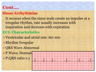 Cont….
Sinus Arrhythmias
It occures when the sinus node create an impulse at a
irregular rhythm, rate usually increases with
inspiration and decrease with expiration
ECG Characteristics
Ventricular and atrial rate :60-100
Rhythm Irregular
QRS Wave Abnormal
P Wave; Normal
P:QRS ratio-1:1
 