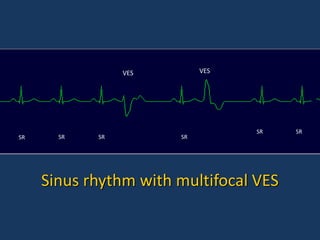 362467948-Cardiac-Emergency-ACLS-ppt.ppt