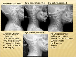 6yo asthma /ear infect 8yo asthma /ear infect10 yo asthma/ ear infect
12 yo asthma/ ear infect
No Chiropractic Care
Multiple vaccinations
Multiple courses antibiotics
Synthetic foods
No Enzymes
Tylenol
Advil
American Children
1: 38 autistic
14% special needs
10% min.Brain injury
74 doses of 16 vac.
(1/2 % of 1% mom’s
have Hep B)
 