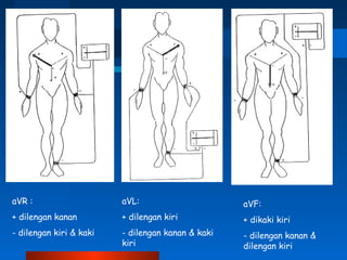 aVR :
+ dilengan kanan
- dilengan kiri & kaki
aVL:
+ dilengan kiri
- dilengan kanan & kaki
kiri
aVF:
+ dikaki kiri
- dilengan kanan &
dilengan kiri
 