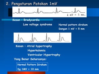 2. Pengaturan Patokan 1mV2. Pengaturan Patokan 1mV
Kesan : Bradycardia
Low voltage syndrome Normal pattern direkam
Dengan 1 mV = 5 mm
Kesan : Atrial hypertrophy
Hyperkalemia
Ventricular Hypertrophy
Yang Benar Seharusnya:
Normal Pattern Direkam
Dg 1MV = 10 mm
 