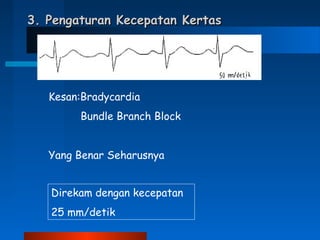 3. Pengaturan Kecepatan Kertas3. Pengaturan Kecepatan Kertas
Kesan:Bradycardia
Bundle Branch Block
Yang Benar Seharusnya
Direkam dengan kecepatan
25 mm/detik
 