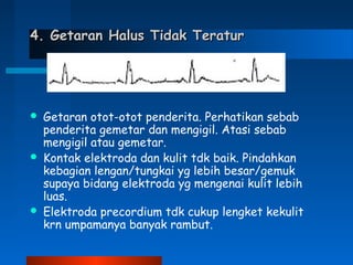 4. Getaran Halus Tidak Teratur4. Getaran Halus Tidak Teratur
 Getaran otot-otot penderita. Perhatikan sebab
penderita gemetar dan mengigil. Atasi sebab
mengigil atau gemetar.
 Kontak elektroda dan kulit tdk baik. Pindahkan
kebagian lengan/tungkai yg lebih besar/gemuk
supaya bidang elektroda yg mengenai kulit lebih
luas.
 Elektroda precordium tdk cukup lengket kekulit
krn umpamanya banyak rambut.
 