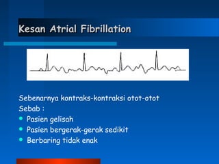 Kesan Atrial FibrillationKesan Atrial Fibrillation
Sebenarnya kontraks-kontraksi otot-otot
Sebab :
 Pasien gelisah
 Pasien bergerak-gerak sedikit
 Berbaring tidak enak
 