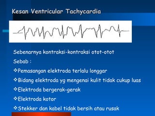 Kesan Ventricular TachycardiaKesan Ventricular Tachycardia
Sebenarnya kontraksi-kontraksi otot-otot
Sebab :
Pemasangan elektroda terlalu longgar
Bidang elektroda yg mengenai kulit tidak cukup luas
Elektroda bergerak-gerak
Elektroda kotor
Stekker dan kabel tidak bersih atau rusak
 
