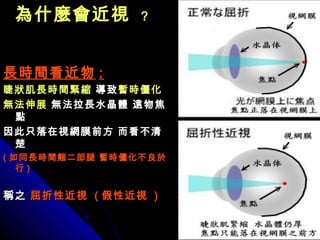 為什麼會近視為什麼會近視 ??
長時間看近物長時間看近物 ::
睫狀肌長時間緊縮睫狀肌長時間緊縮 導致導致暫時僵化暫時僵化
無法伸展無法伸展 無法拉長水晶體 遠物焦無法拉長水晶體 遠物焦
點點
因此只落在視網膜前方 而看不清因此只落在視網膜前方 而看不清
楚楚
(( 如同長時間翹二郎腿 暫時僵化不良於如同長時間翹二郎腿 暫時僵化不良於
行行 ))
稱之稱之 屈折性近視屈折性近視 (( 假性近視假性近視 ))
 