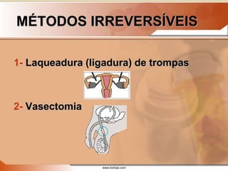 www.bioloja.com
MÉTODOS IRREVERSÍVEIS
1- Laqueadura (ligadura) de trompas
2- Vasectomia
 