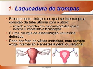 www.bioloja.com
1- Laqueadura de trompas
• Procedimento cirúrgico no qual se interrompe a
conexão da tuba uterina com o útero:
– impede o encontro dos espermatozóides com o
ovócito II, impedindo a fecundação.
• É uma cirurgia de esterilização voluntária
definitiva.
• Pode ser feita de várias maneiras, mas sempre
exige internação e anestesia geral ou regional.
 