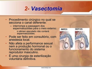 www.bioloja.com
2- Vasectomia
• Procedimento cirúrgico no qual se
secciona o canal deferente:
– interrompe a passagem dos
espermatozóides para o meio externo:
• o sêmen ejaculado não conterá
espermatozóides.
• Pode ser feito em consultório, com
anestesia local.
• Não afeta a performance sexual
nem a produção hormonal ou o
funcionamento do sistema
reprodutor masculino.
• É uma cirurgia de esterilização
voluntária definitiva.
 