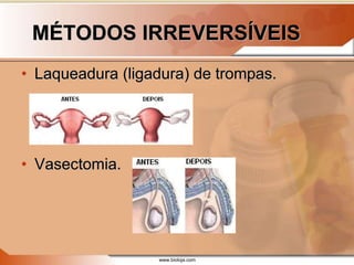 www.bioloja.com
MÉTODOS IRREVERSÍVEIS
• Laqueadura (ligadura) de trompas.
• Vasectomia.
 