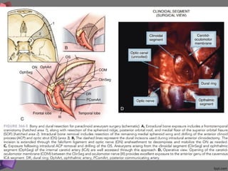 366 Microsurgery of paraclinoid aneurysm | PPT