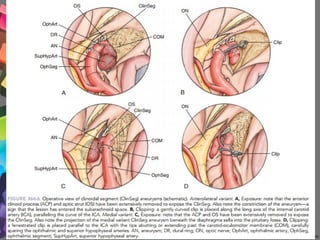 366 Microsurgery of paraclinoid aneurysm | PPT