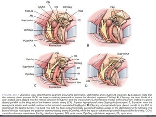 366 Microsurgery of paraclinoid aneurysm | PPT