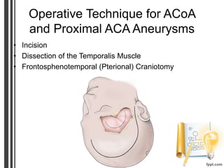 Operative Technique for ACoA
and Proximal ACA Aneurysms
• Incision
• Dissection of the Temporalis Muscle
• Frontosphenotemporal (Pterional) Craniotomy
 