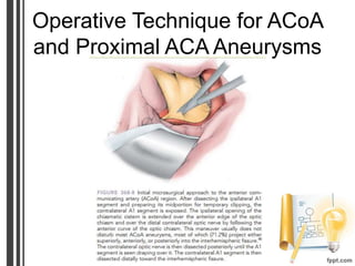 Operative Technique for ACoA
and Proximal ACA Aneurysms
 